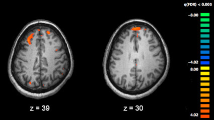 Учёные пришли к выводу, что мозг людей, больных шизофренией, работает не у всех одинаково